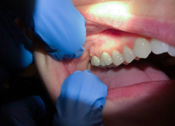 Best Emergency Dentist for Knocked-Out Tooth in Port Allen, LA